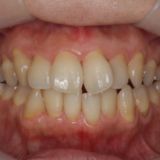 歯列拡大とアライナー矯正の併用により非抜歯で叢生を改善した症例