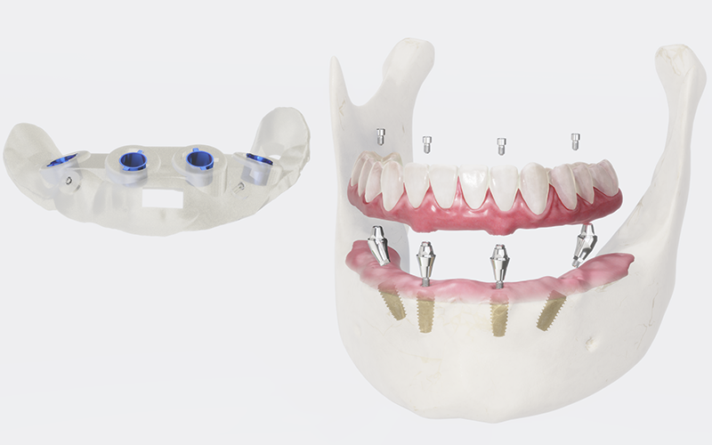 大崎オーバルコート歯科・矯正歯科室のインプラント
