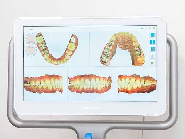 大崎オーバルコート歯科・矯正歯科室の口腔内スキャナー
