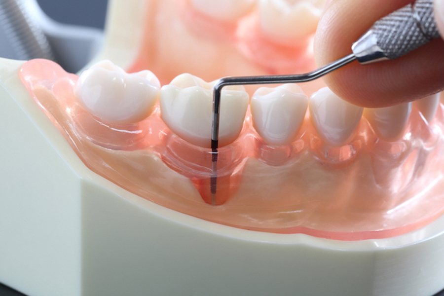歯周病治療 - 大崎・五反田の歯医者｜痛みに配慮した丁寧な治療【大崎