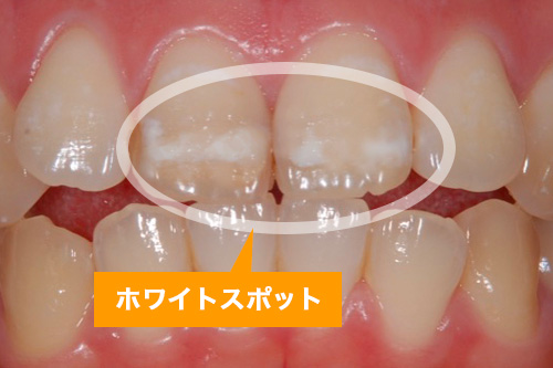 ホワイトスポット治療とは｜原因・治し方を大崎の歯科医が解説｜大崎