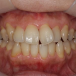 歯列拡大とアライナー矯正の併用により非抜歯で叢生を改善した症例