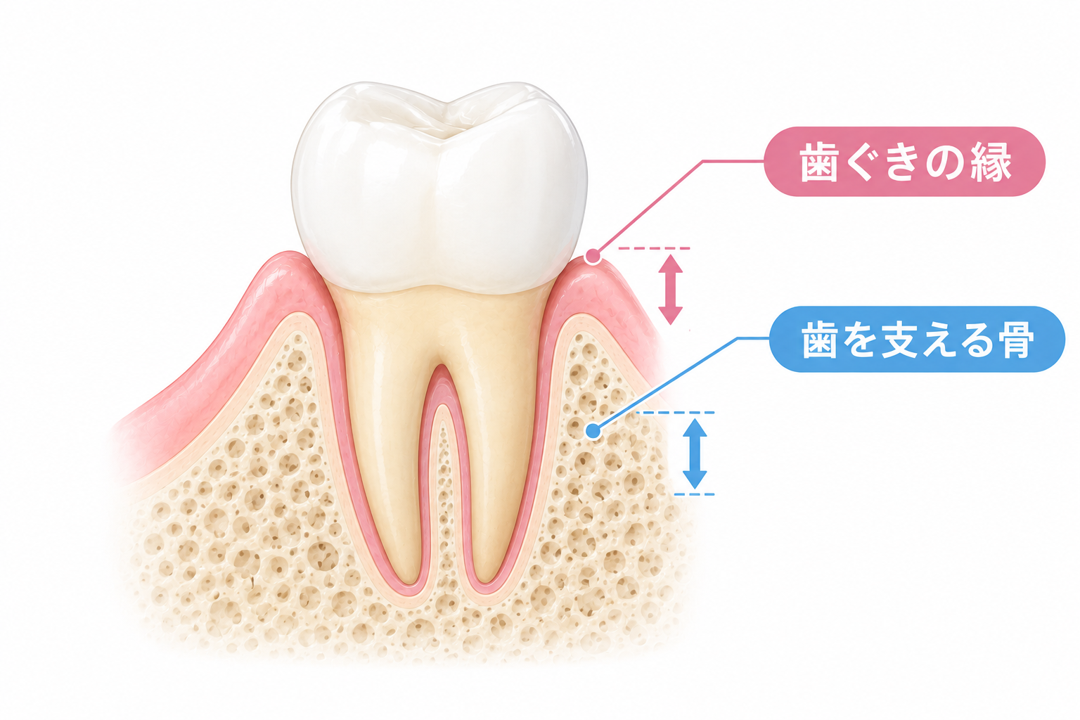 下がった歯ぐきは自然には戻らない・目標はこれ以上下げないこと