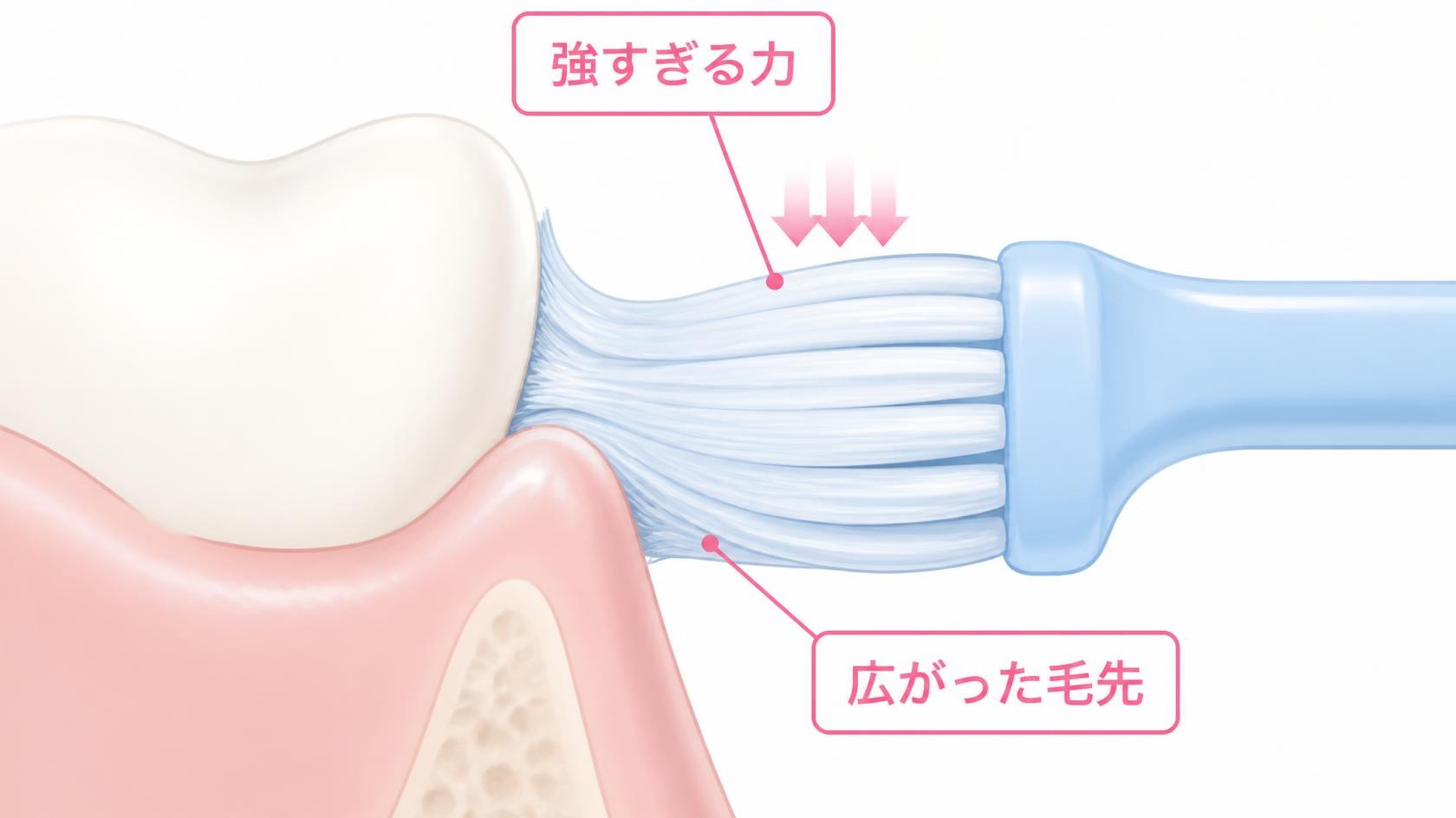 歯ぐきが下がる5つの原因