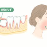 親知らずを抜いた後に頬が腫れる様子