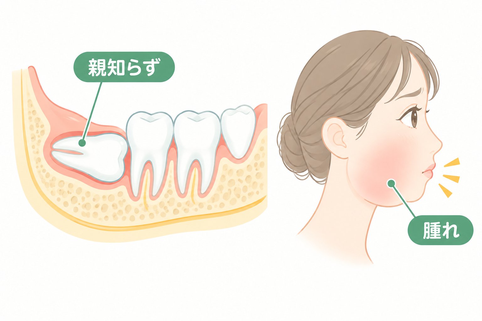 親知らずを抜いた後に頬が腫れる様子