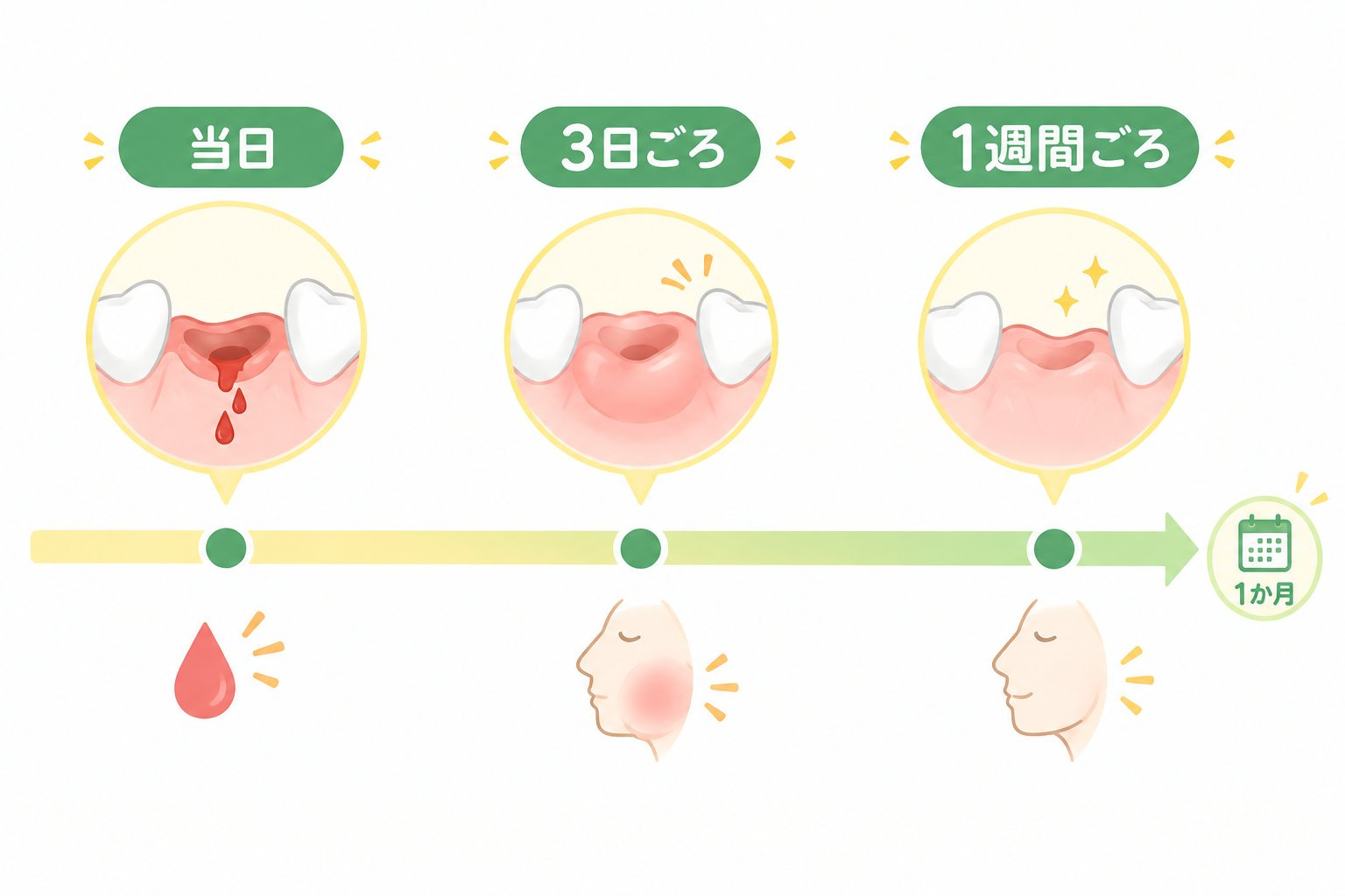 抜歯後の経過の目安（当日・3日ごろ・1週間ごろ・1か月）