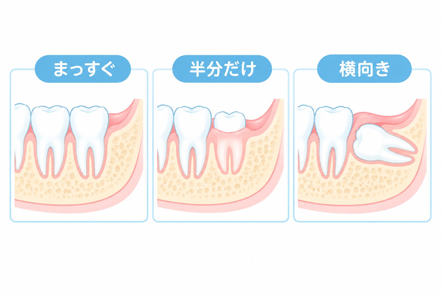 親知らずの生え方（まっすぐ・半分だけ・横向き）