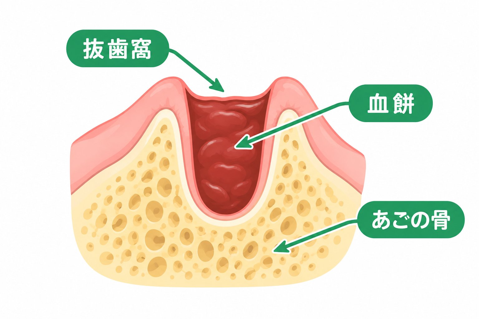 抜歯窩と血餅とあごの骨