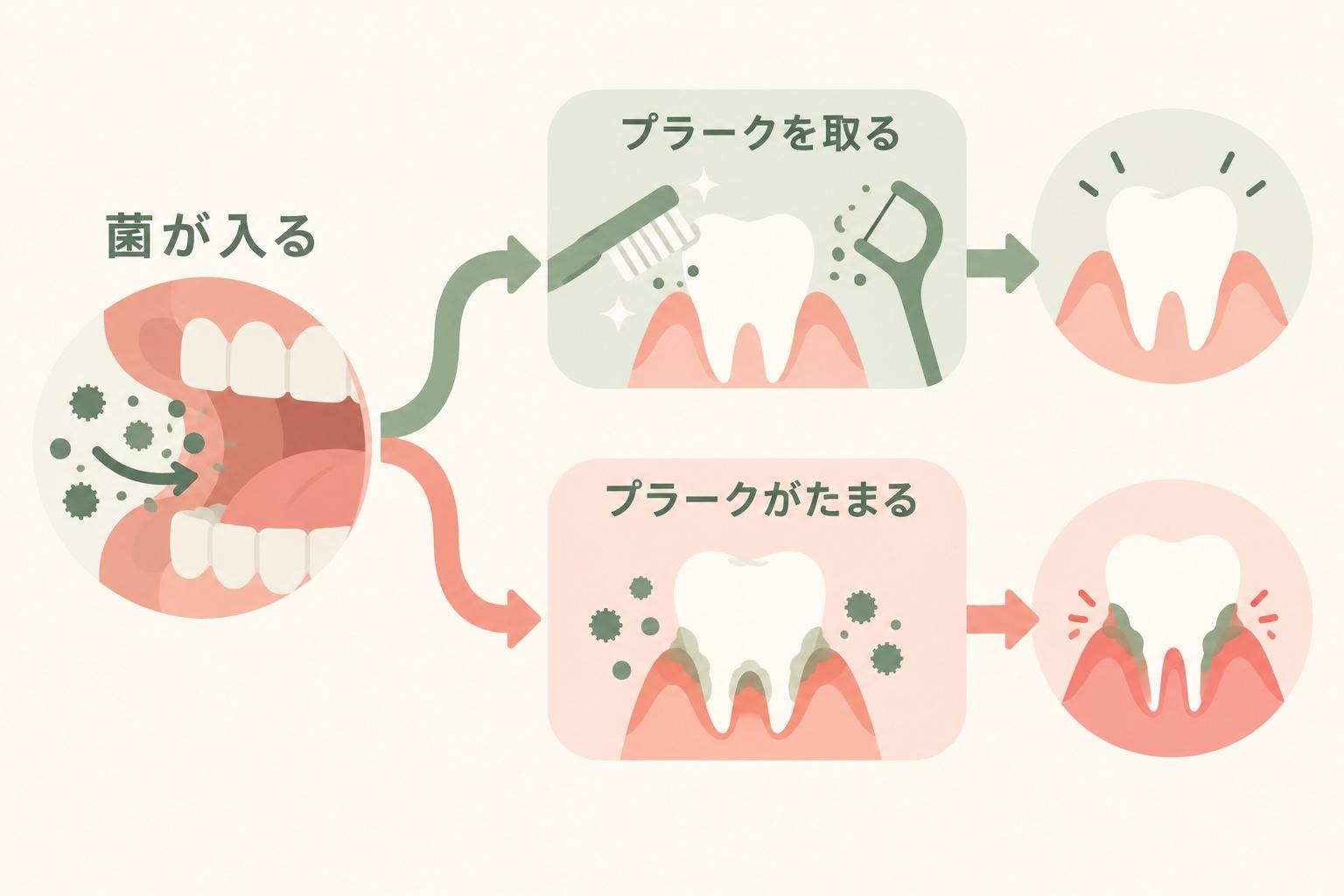 菌が入っても、プラークを取れば健康、たまると歯ぐきが腫れる分かれ道の図